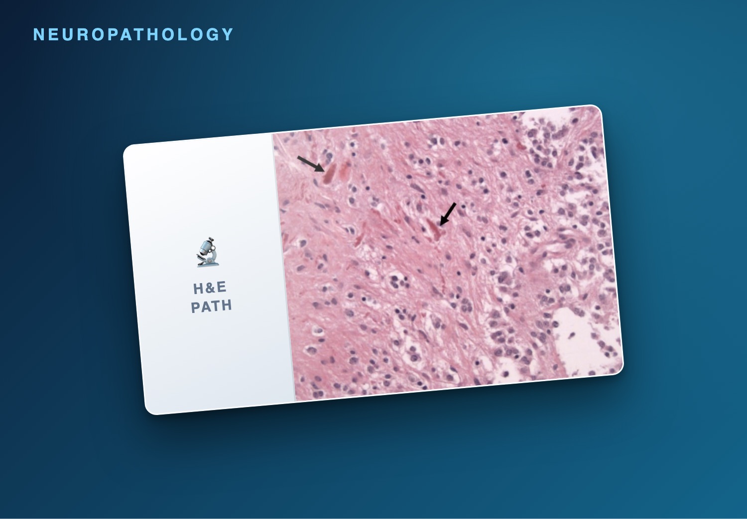 Neuropathology atlas — pilocytic astrocytoma with Rosenthal fibers