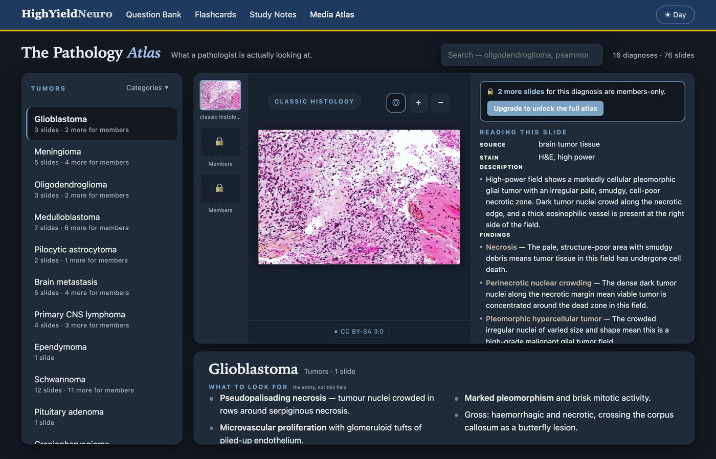Pathology Atlas: a glioblastoma slide with what to look for and the findings explained