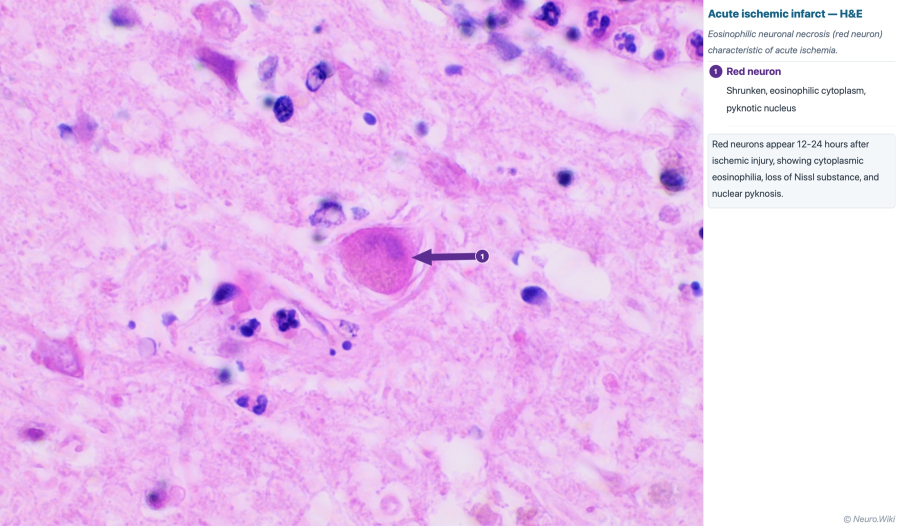 Photomicrograph, ischemic infarct