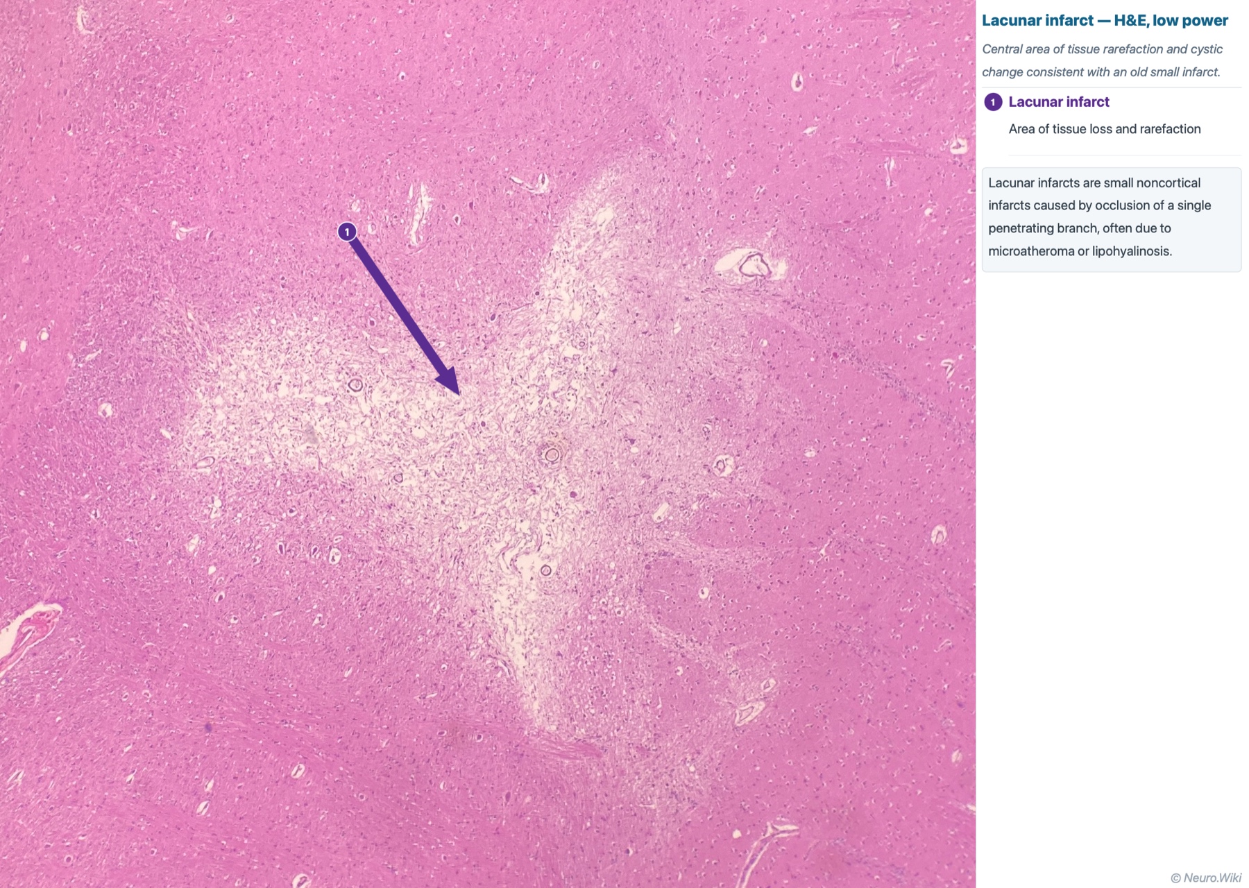 Photomicrograph, thalamus