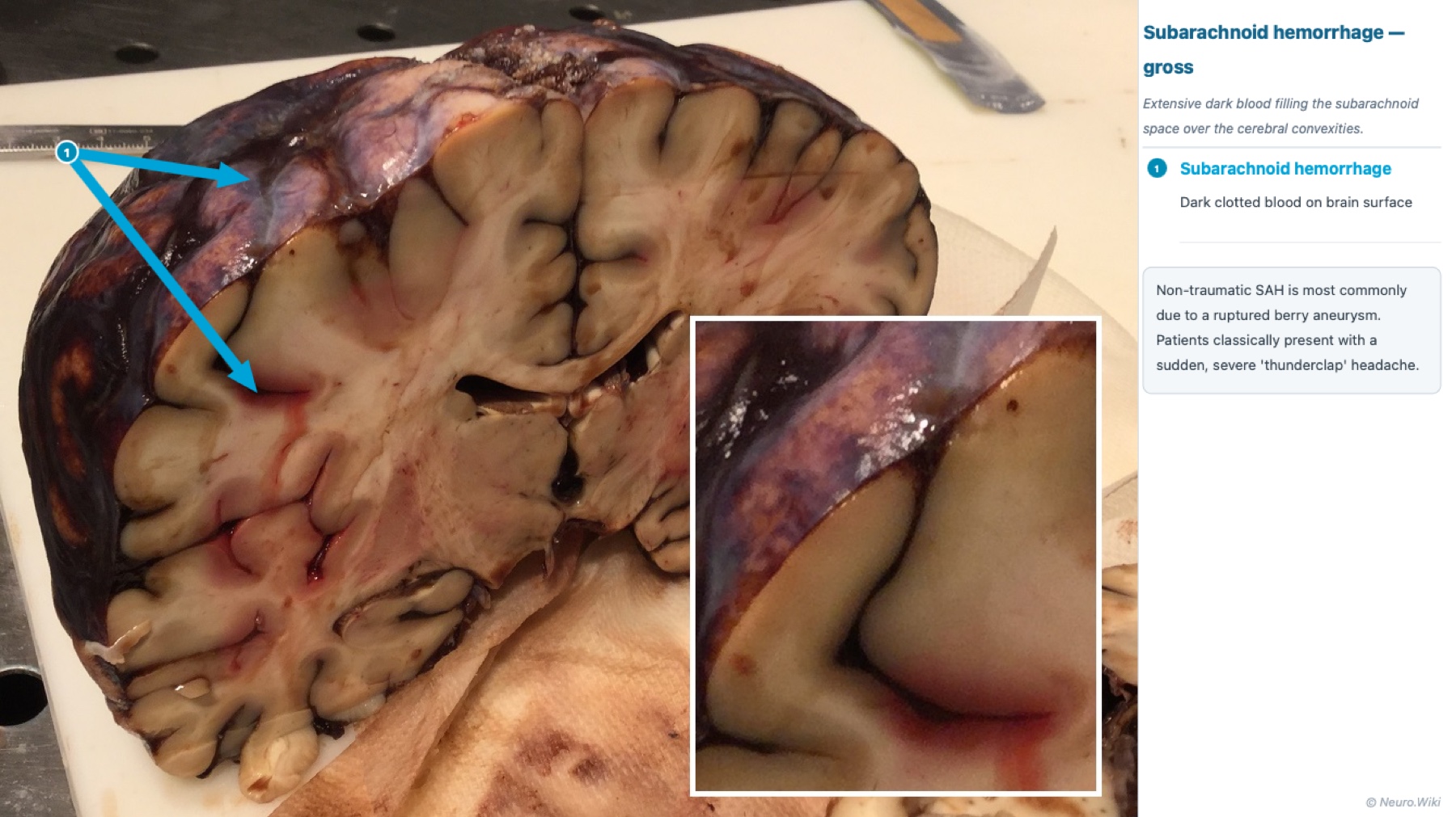Gross brain specimen