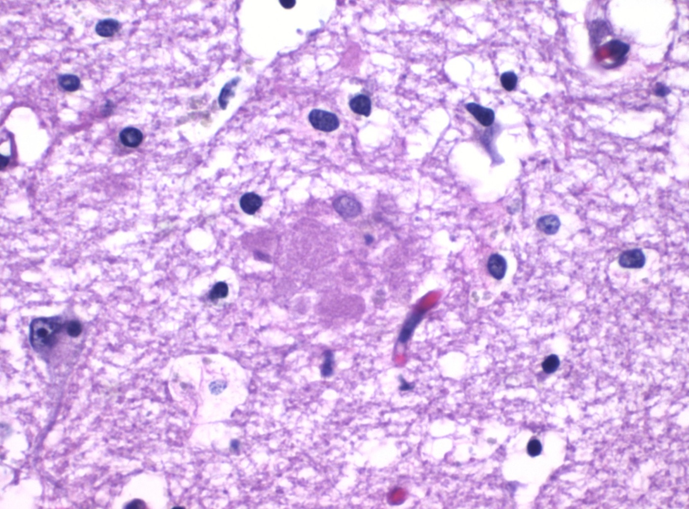 Alzheimer amyloid plaque histology