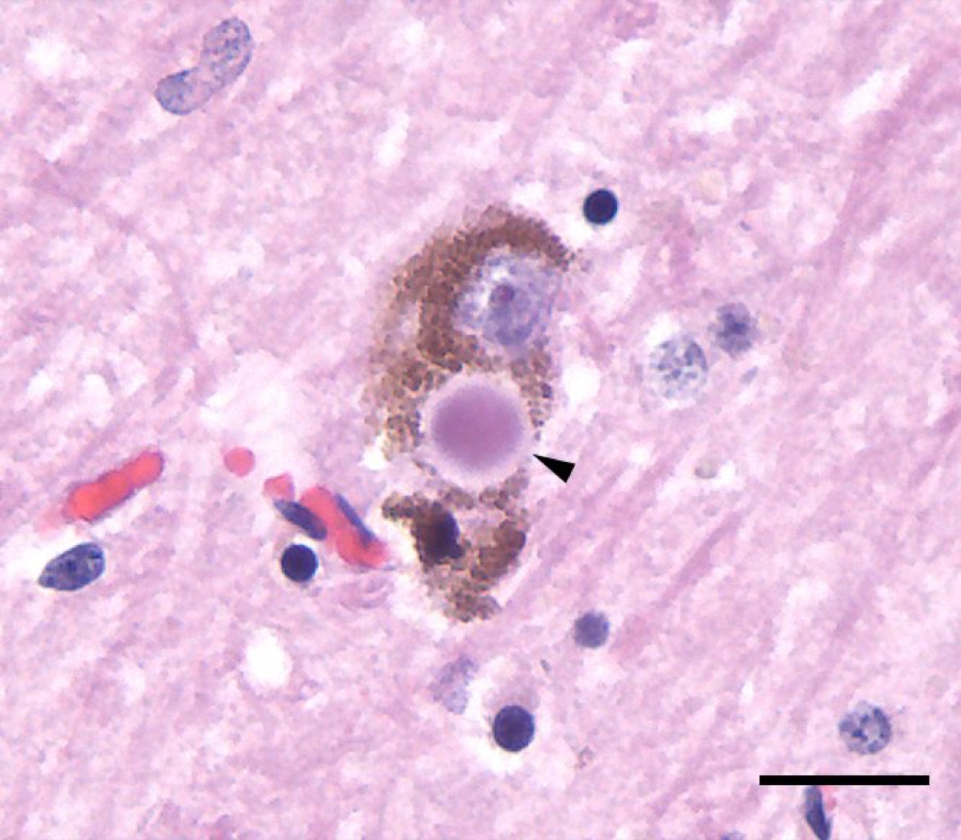 Parkinson Lewy body histology