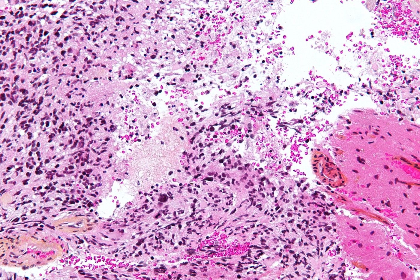 Glioblastoma histology