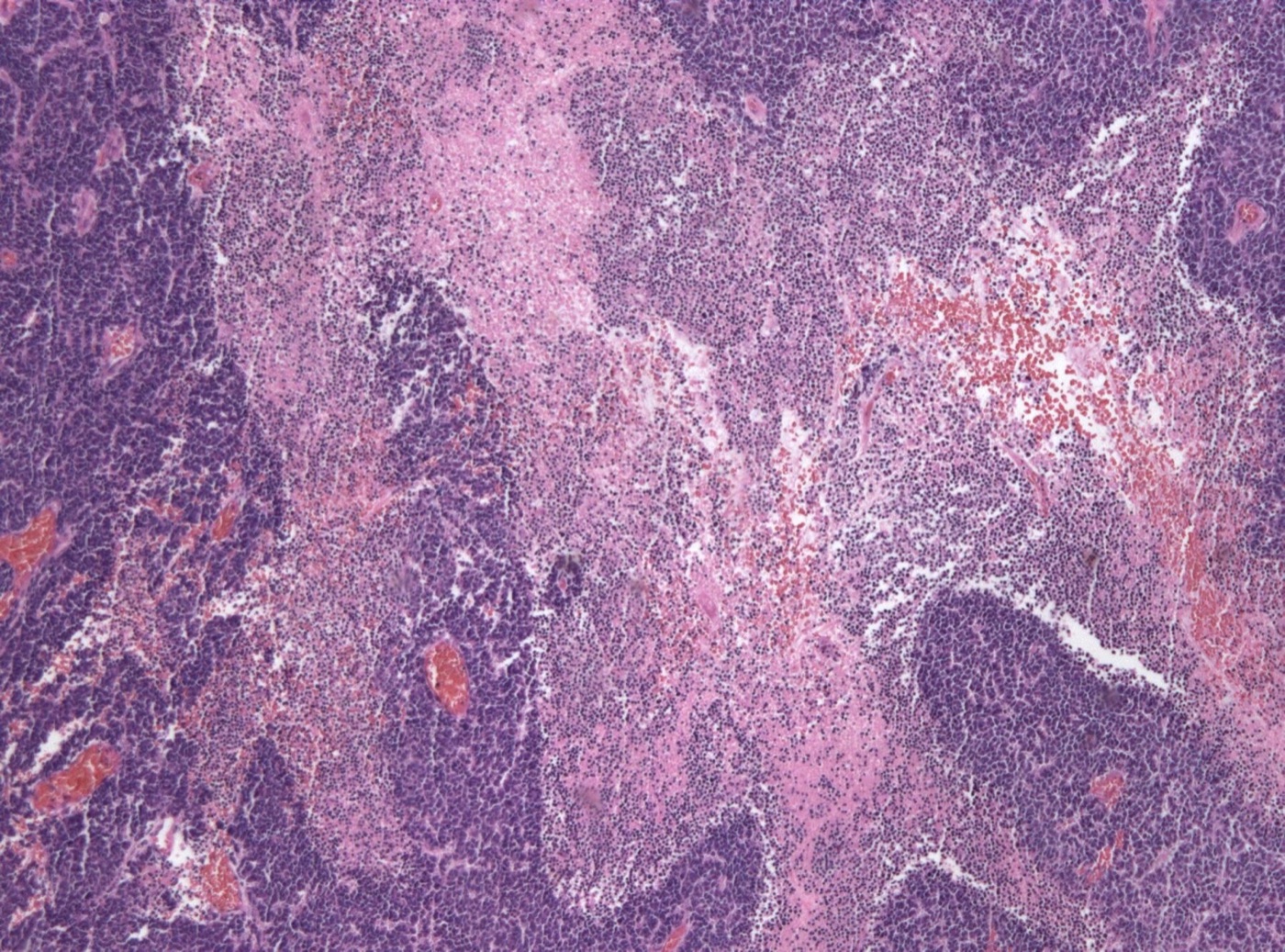 Medulloblastoma histology