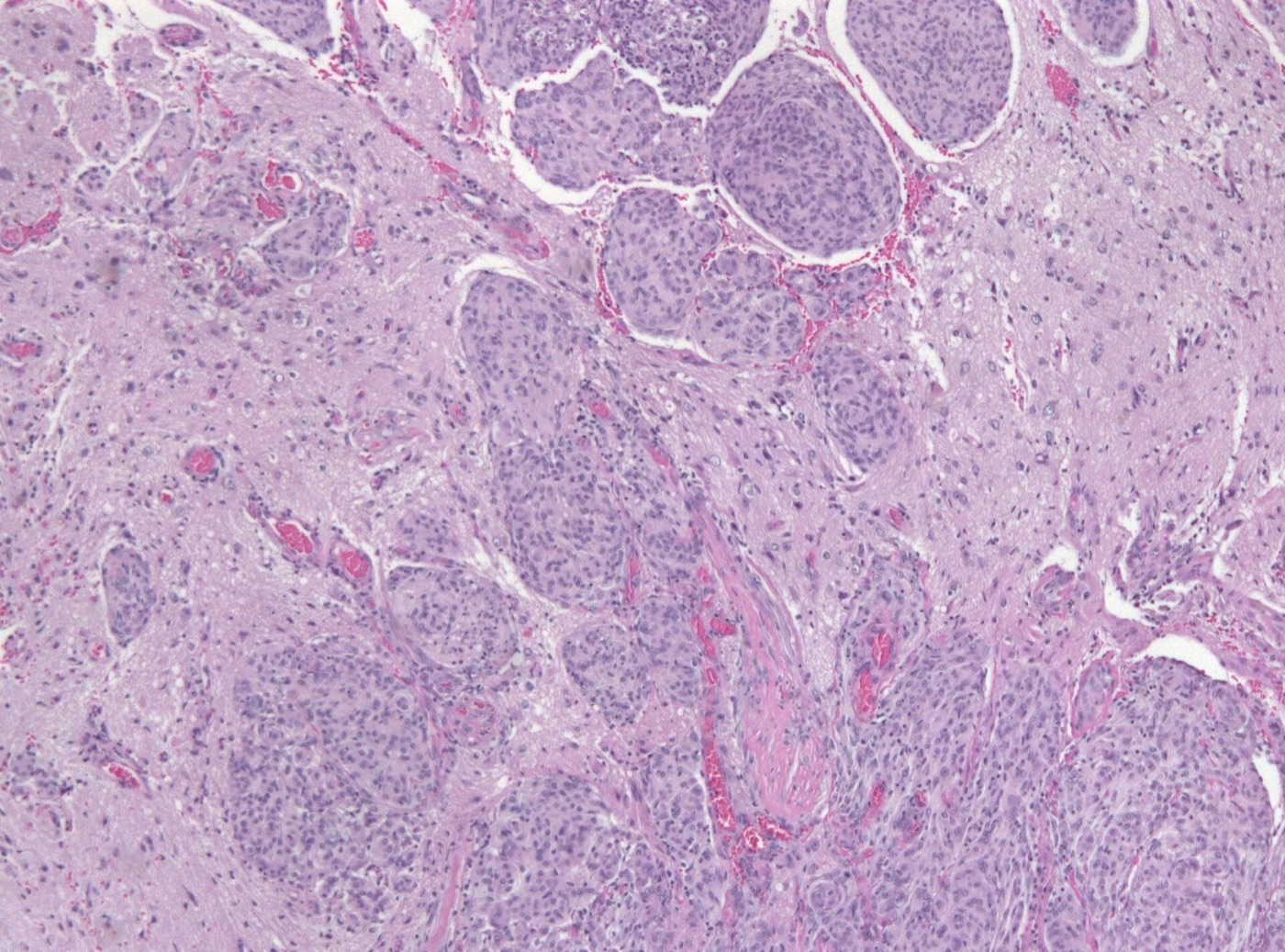 Meningioma histology