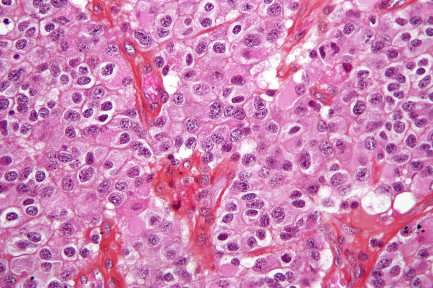 Oligodendroglioma histology
