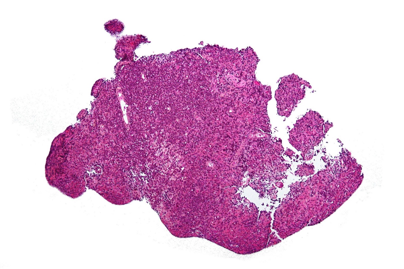 Primary CNS lymphoma histology