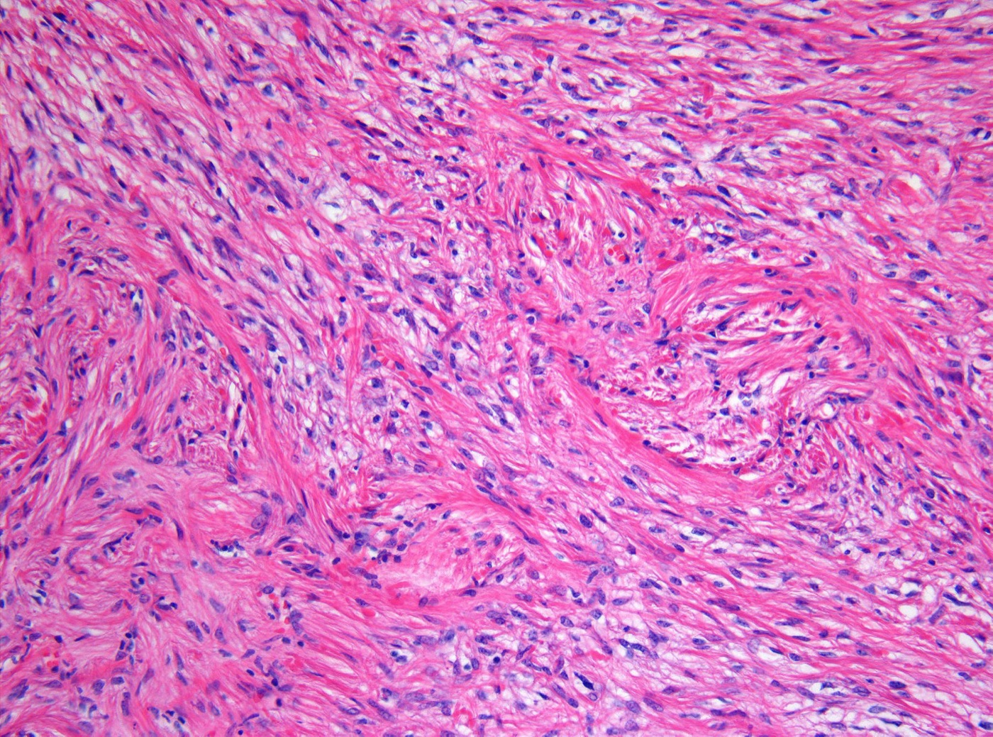 Pilocytic astrocytoma histology