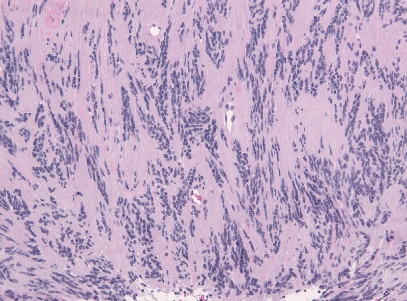 Schwannoma Antoni A histology